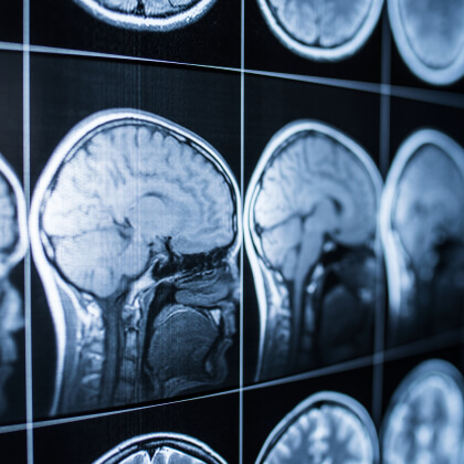 Brain Injury